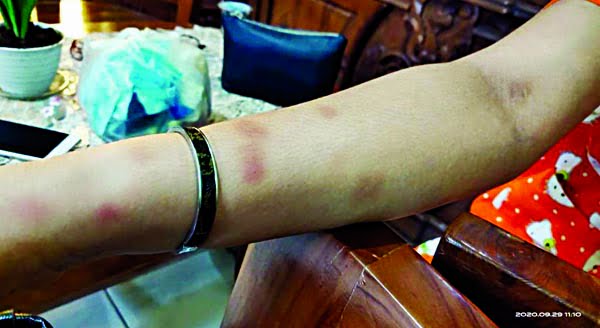 LUKA MEMAR— Korban Welly Yusafitri (35) memperlihatkan luka memar akibat mengalami KDRT oleh suaminya hingga dilaporkan ke Polisi.