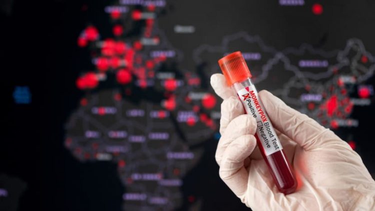 IDI Duga Cacar Monyet sudah Masuk Indonesia tapi Tak Terdeteksi 1 Cacar Monyet Tes iStock 750x423 1