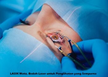 LASIK Mata, Bedah Laser untuk Penglihatan yang Sempurna