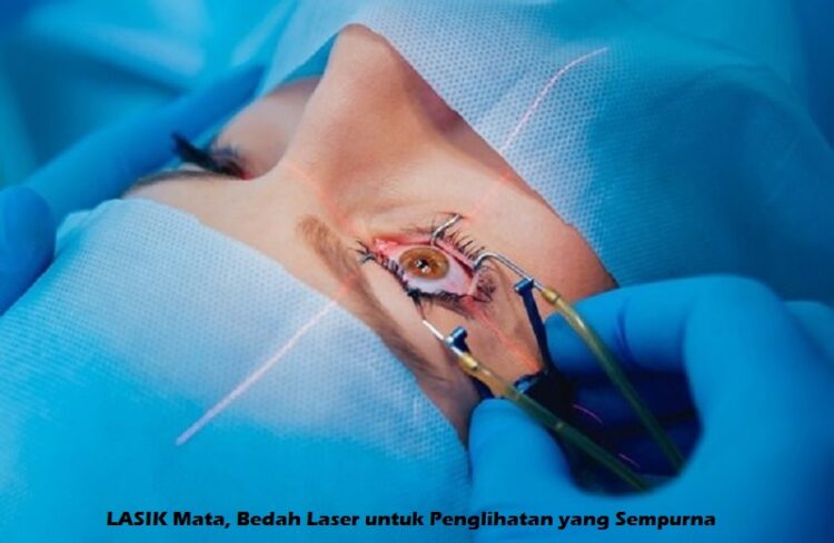 LASIK Mata, Bedah Laser untuk Penglihatan yang Sempurna 1 1. LASIK Mata Bedah Laser untuk Penglihatan yang Sempurna icarefamilyvision.com