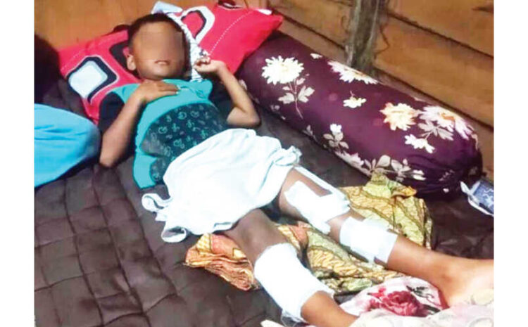 DISERANG BUAYA— Kondisi bocah berusia 7 tahun bernama Shakel Alfaris usai diserang buaya saat mandi-mandi di Pantai Air Manis Jorong Kampung Padang Utara, Nagari Air Bangis, Kecamatan Sungai Beremas, Kabupaten Pasaman Barat, Senin (15/12) sekitar pukul 12.00 WIB.